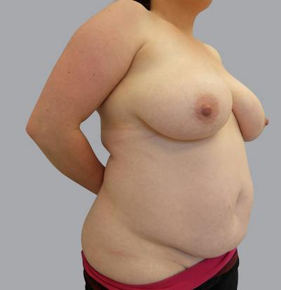 Mommy Makeover Before & After Gallery - Patient 55495969 - Image 3