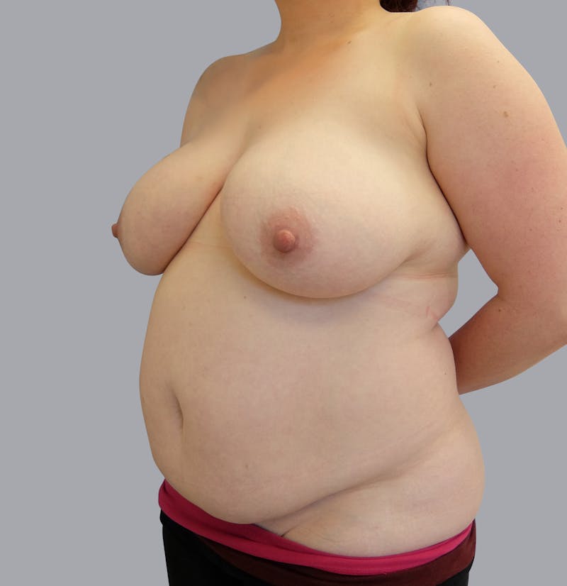 Mommy Makeover Before & After Gallery - Patient 55495969 - Image 5