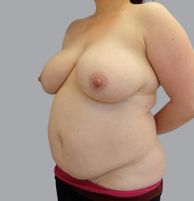 Mommy Makeover Before & After Gallery - Patient 55495969 - Image 5