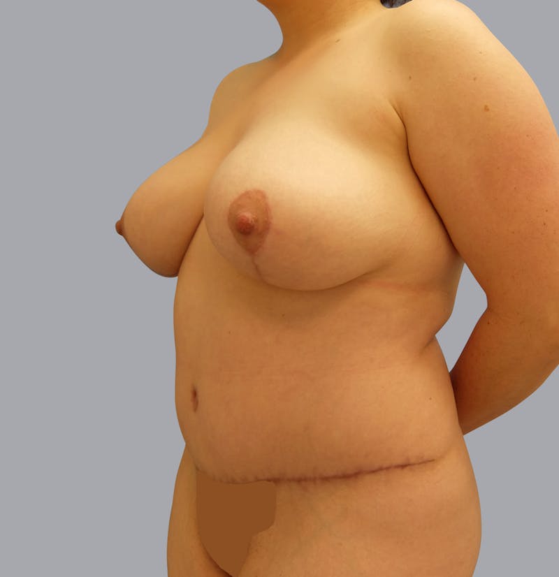 Mommy Makeover Before & After Gallery - Patient 55495969 - Image 6