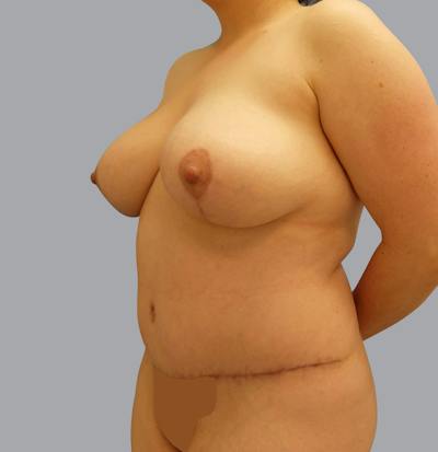 Mommy Makeover Before & After Gallery - Patient 55495969 - Image 6