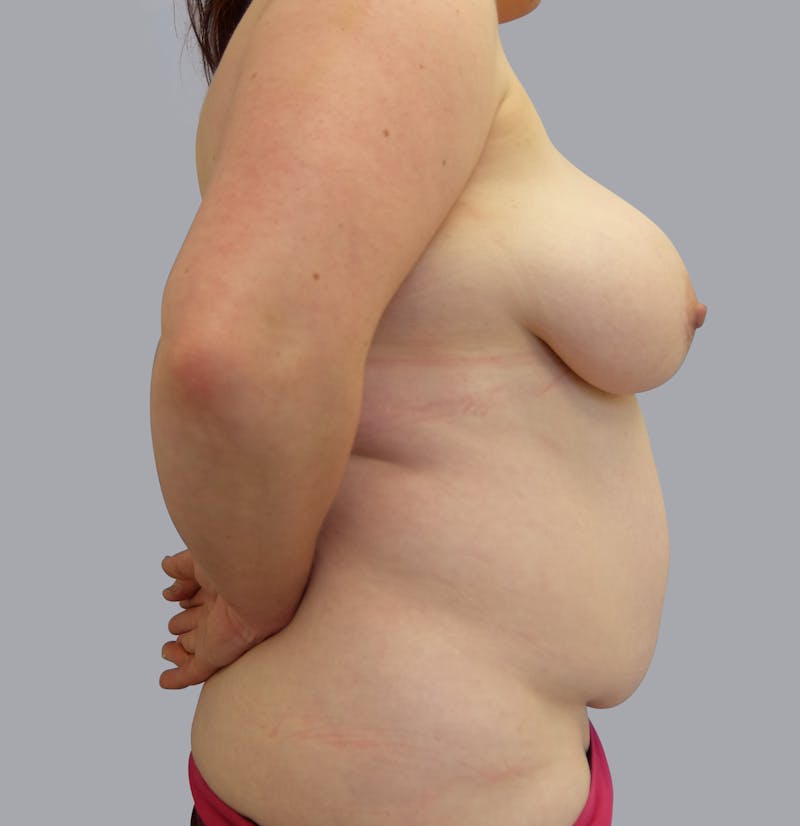 Mommy Makeover Before & After Gallery - Patient 55495969 - Image 7