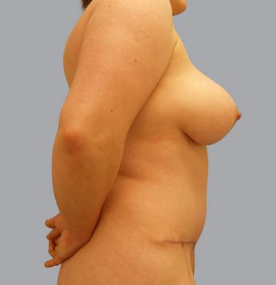 Mommy Makeover Before & After Gallery - Patient 55495969 - Image 8