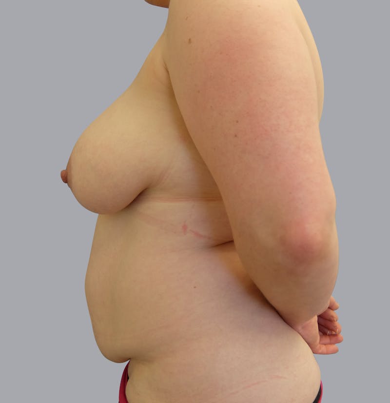 Mommy Makeover Before & After Gallery - Patient 55495969 - Image 9
