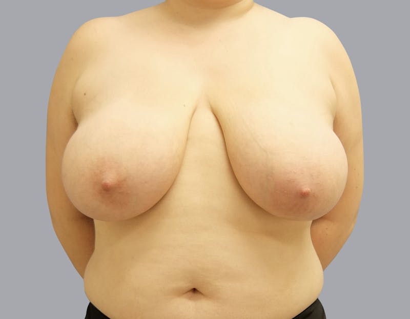 Breast Reduction Gallery - Patient 55333068 - Image 1