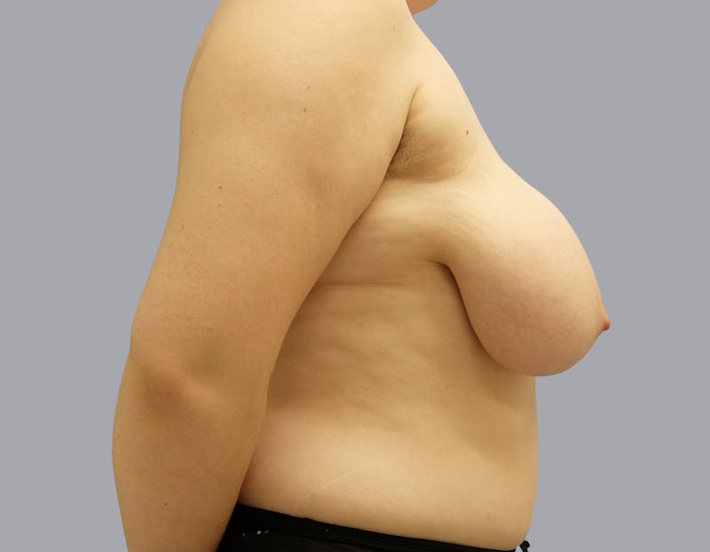 Breast Reduction Gallery - Patient 55333068 - Image 3