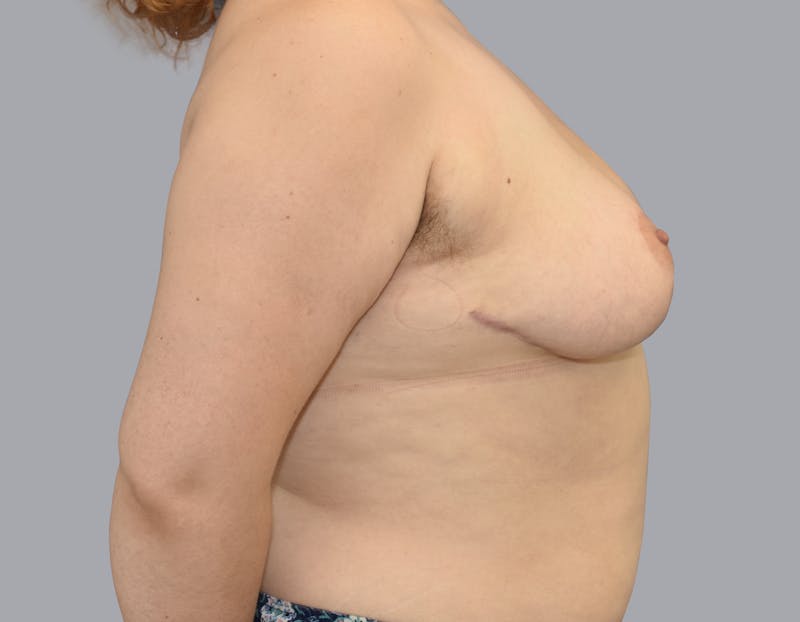 Breast Reduction Gallery - Patient 55333068 - Image 4