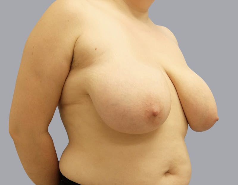 Breast Reduction Gallery - Patient 55333068 - Image 7