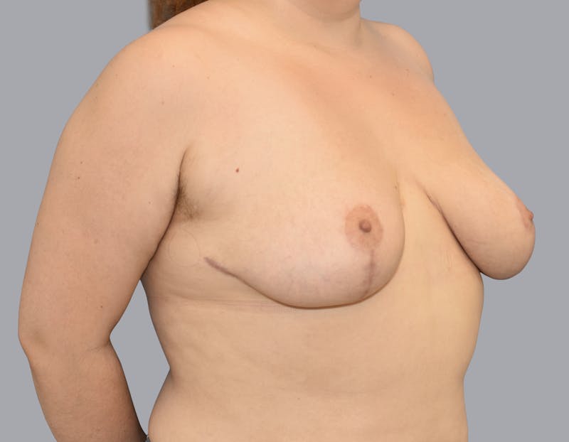 Breast Reduction Gallery - Patient 55333068 - Image 8