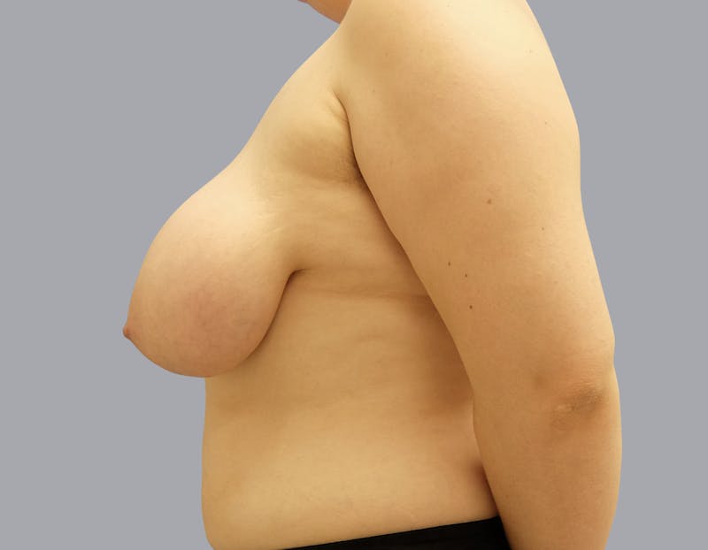 Breast Reduction Before & After Gallery - Patient 55333068 - Image 5