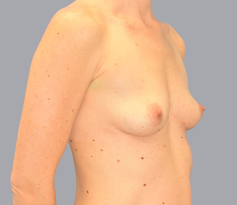 Breast Augmentation Gallery - Patient 55333112 - Image 3