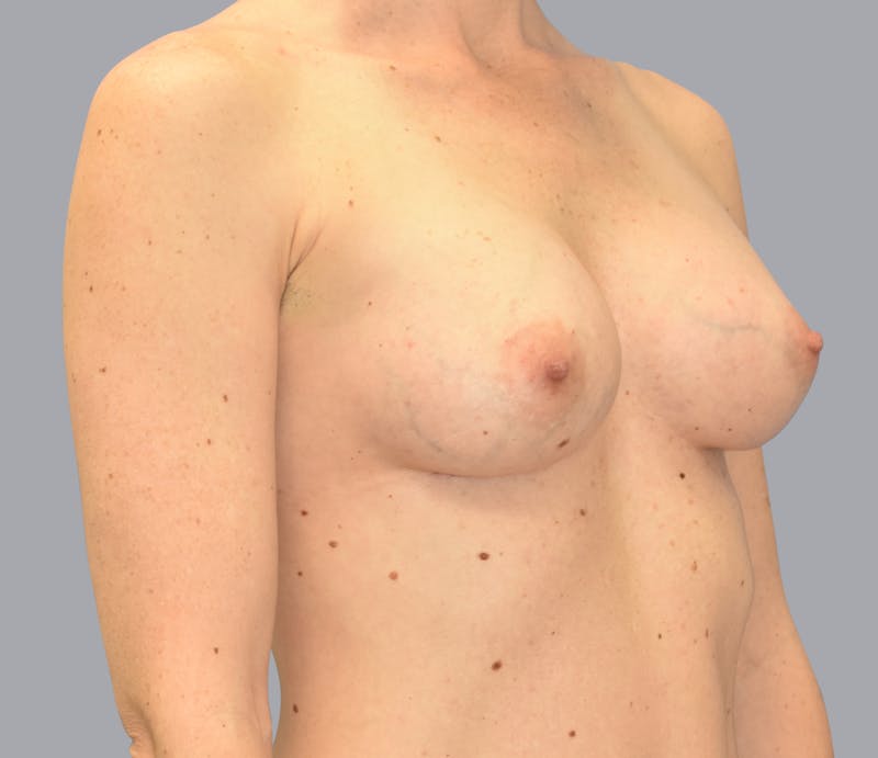 Breast Augmentation Gallery - Patient 55333112 - Image 4