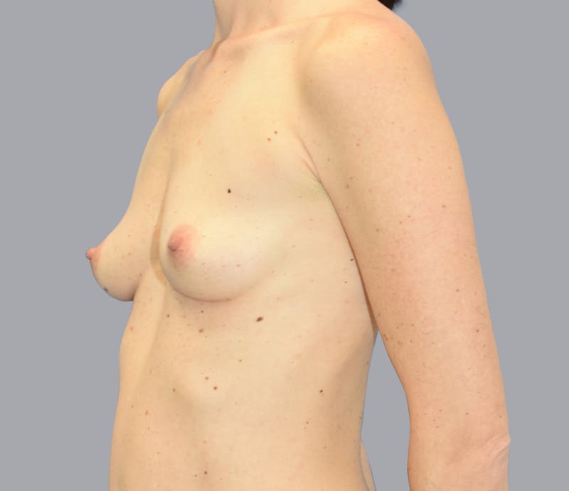 Breast Augmentation Gallery - Patient 55333112 - Image 5