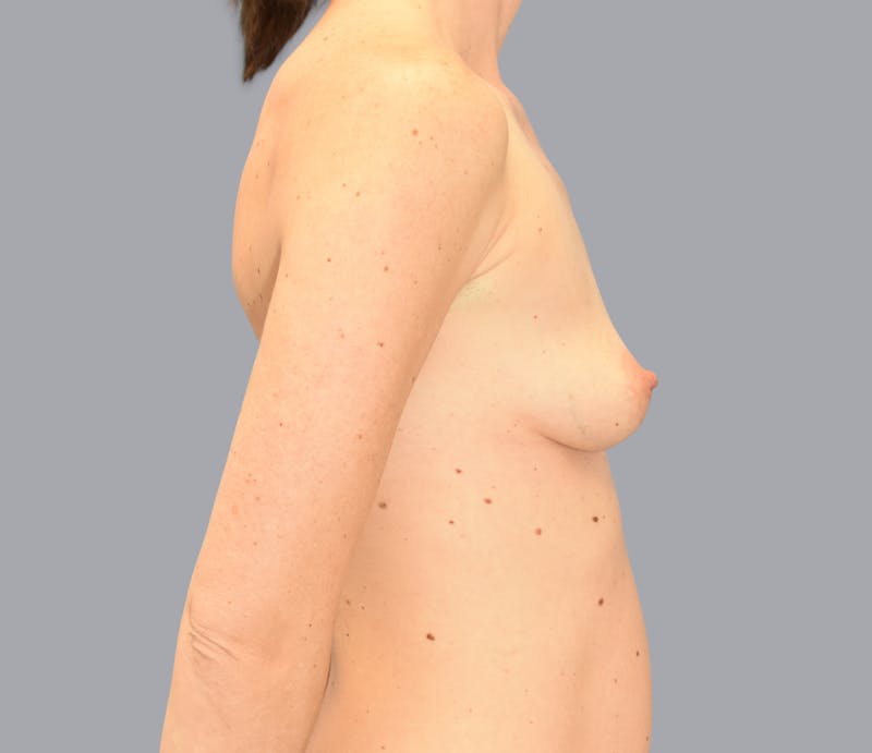 Breast Augmentation Gallery - Patient 55333112 - Image 7