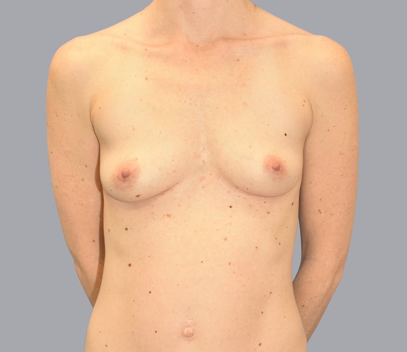 Breast Augmentation Gallery - Patient 55333112 - Image 1