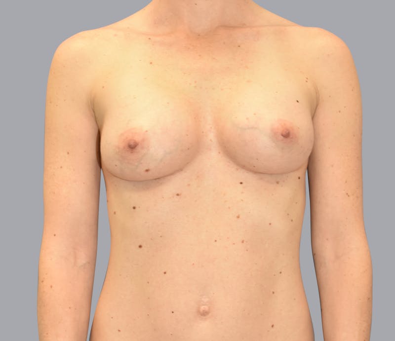 Breast Augmentation Before & After Gallery - Patient 55333112 - Image 2