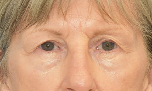 Before and After Blepharoplasty Patient 1