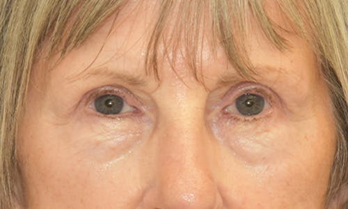 Before and After Blepharoplasty Patient 1