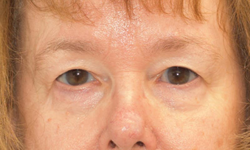 Blepharoplasty Before & After Gallery - Patient 55333028 - Image 1