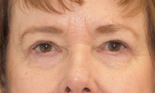 Blepharoplasty in Tampa Before & After Gallery - Patient 55333028 - Image 2