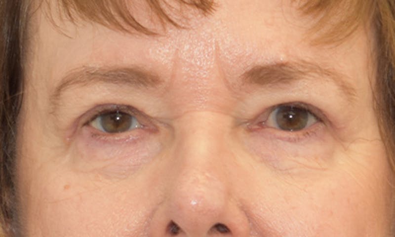 Blepharoplasty Before & After Gallery - Patient 55333028 - Image 2