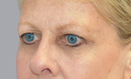 Before and After Blepharoplasty Patient 3
