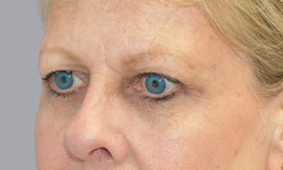 Blepharoplasty Before & After Gallery - Patient 55476647 - Image 1