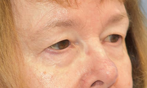 Before and After Blepharoplasty Patient 2