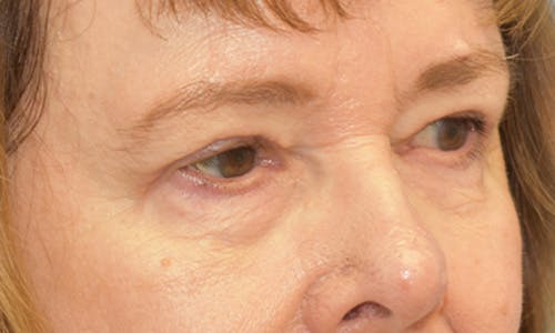Before and After Blepharoplasty Patient 2