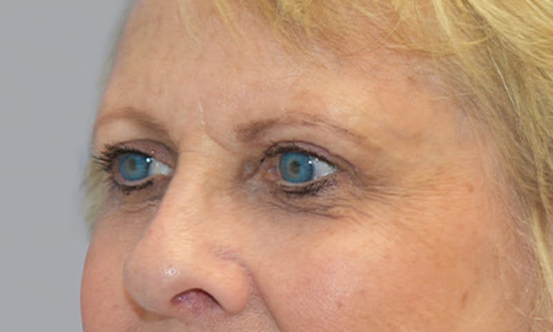 Blepharoplasty Before & After Gallery - Patient 55476647 - Image 2
