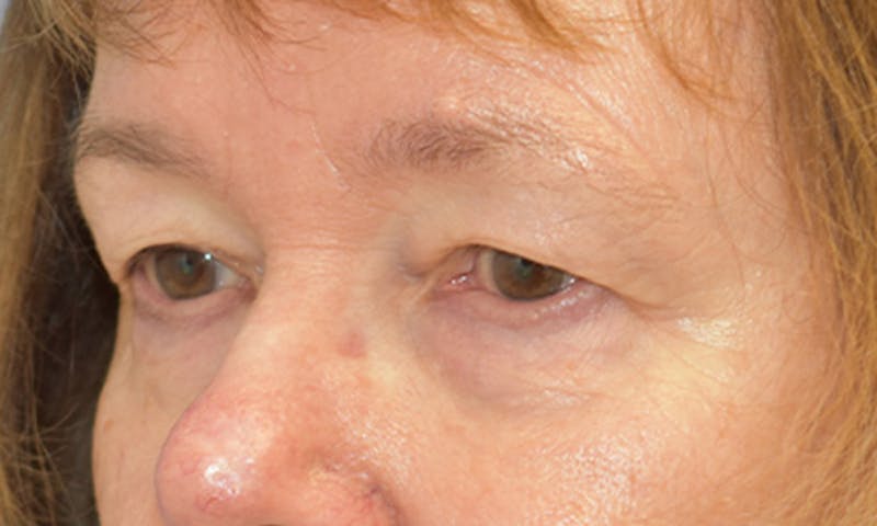 Blepharoplasty Before & After Gallery - Patient 55333028 - Image 5