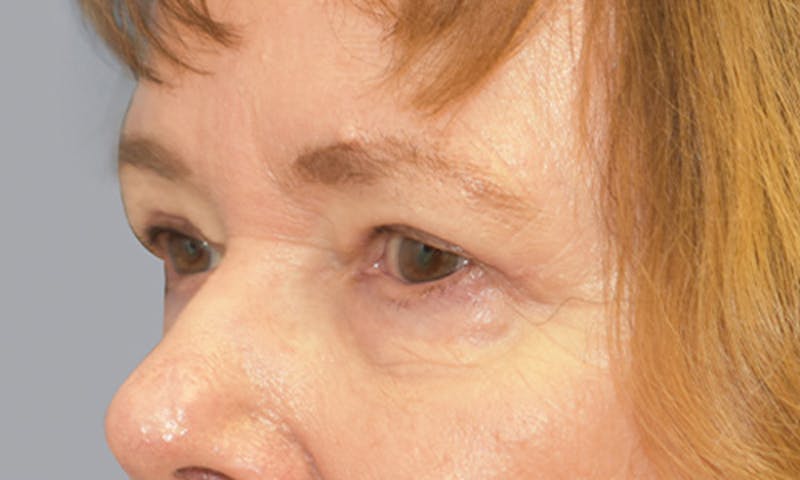 Blepharoplasty Before & After Gallery - Patient 55333028 - Image 6