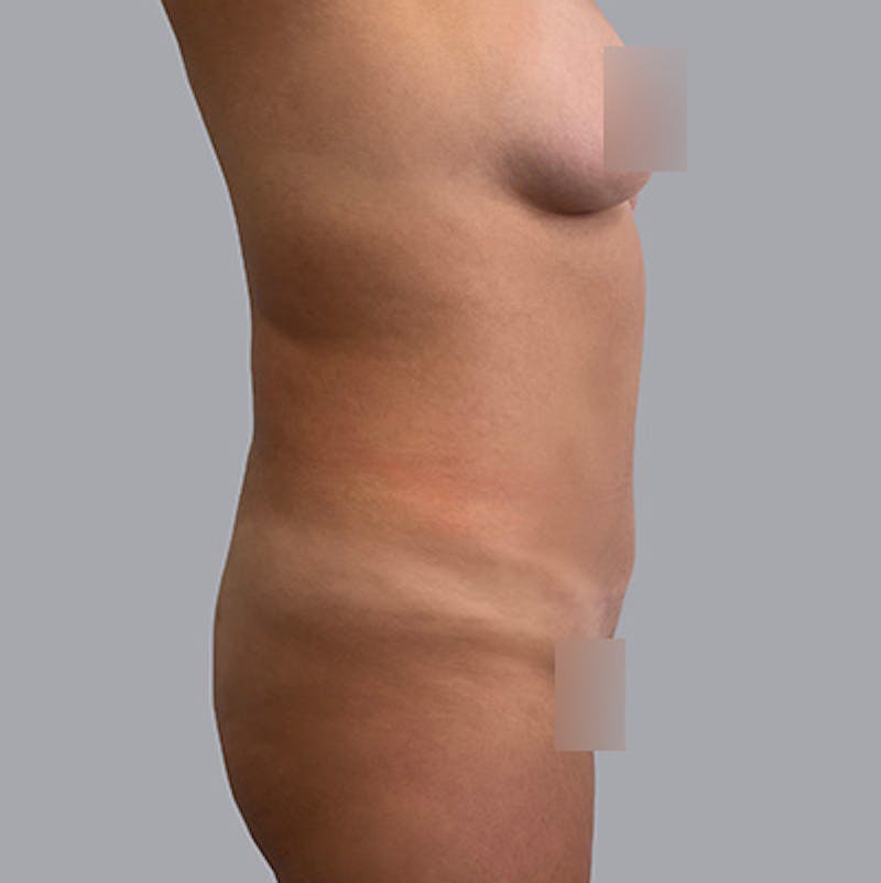 Body Liposuction Before & After Gallery - Patient 208724 - Image 1