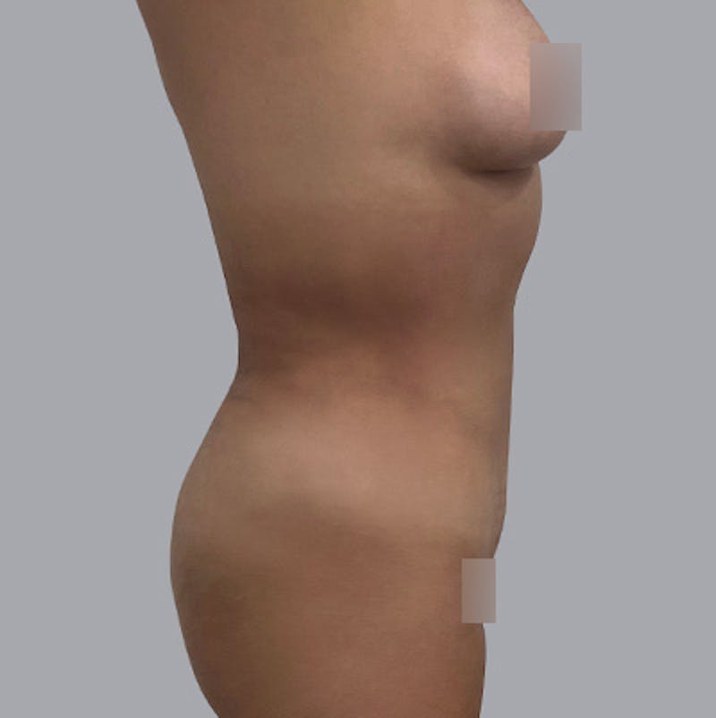 Body Before & After Gallery - Patient 208724 - Image 2