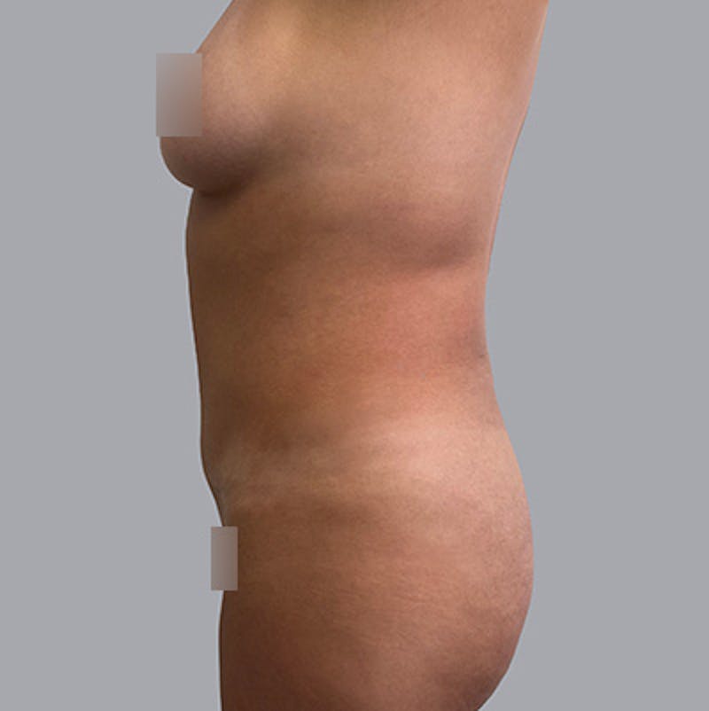 Body Liposuction Before & After Gallery - Patient 208724 - Image 3