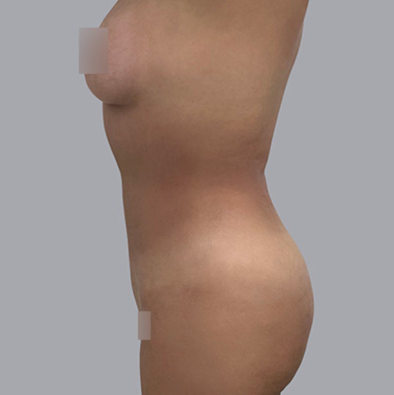 Body Liposuction Before & After Gallery - Patient 208724 - Image 4