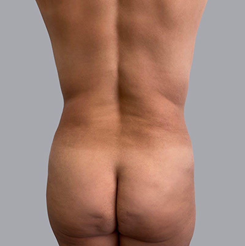Liposuction Before & After Gallery - Patient 63984491 - Image 1