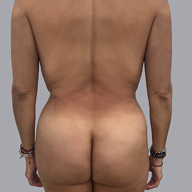Body Liposuction Before & After Gallery - Patient 291783 - Image 2