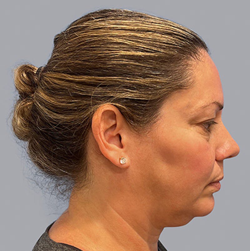 Chin Lipo Before & After Gallery - Patient 106446250 - Image 1