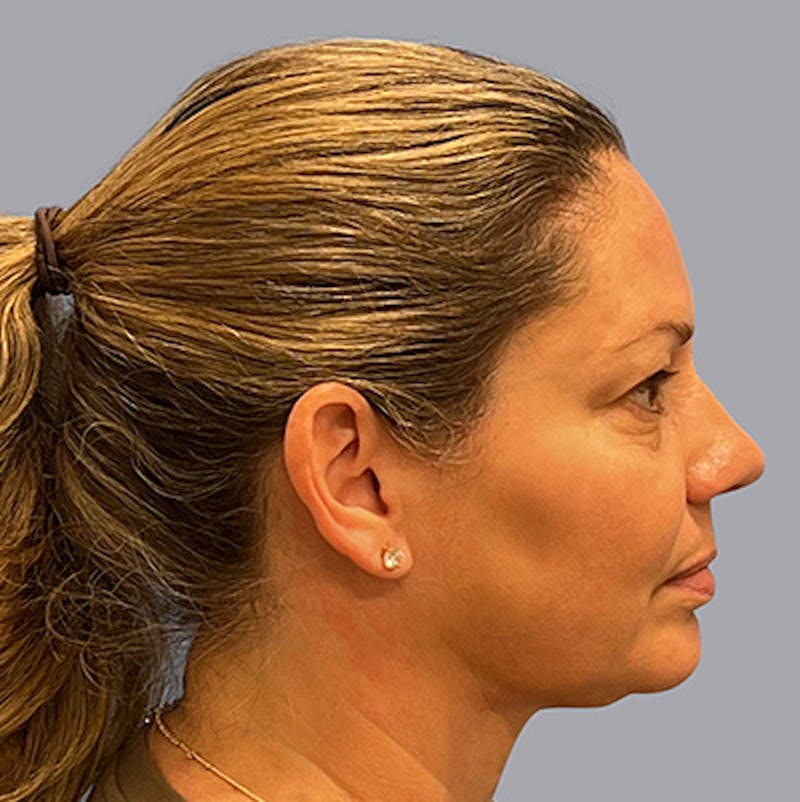 Chin Lipo Before & After Gallery - Patient 106446250 - Image 2