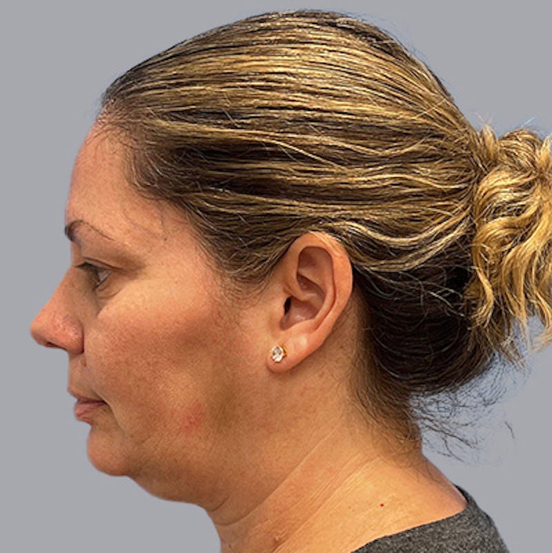 Chin Lipo Before & After Gallery - Patient 106446250 - Image 3