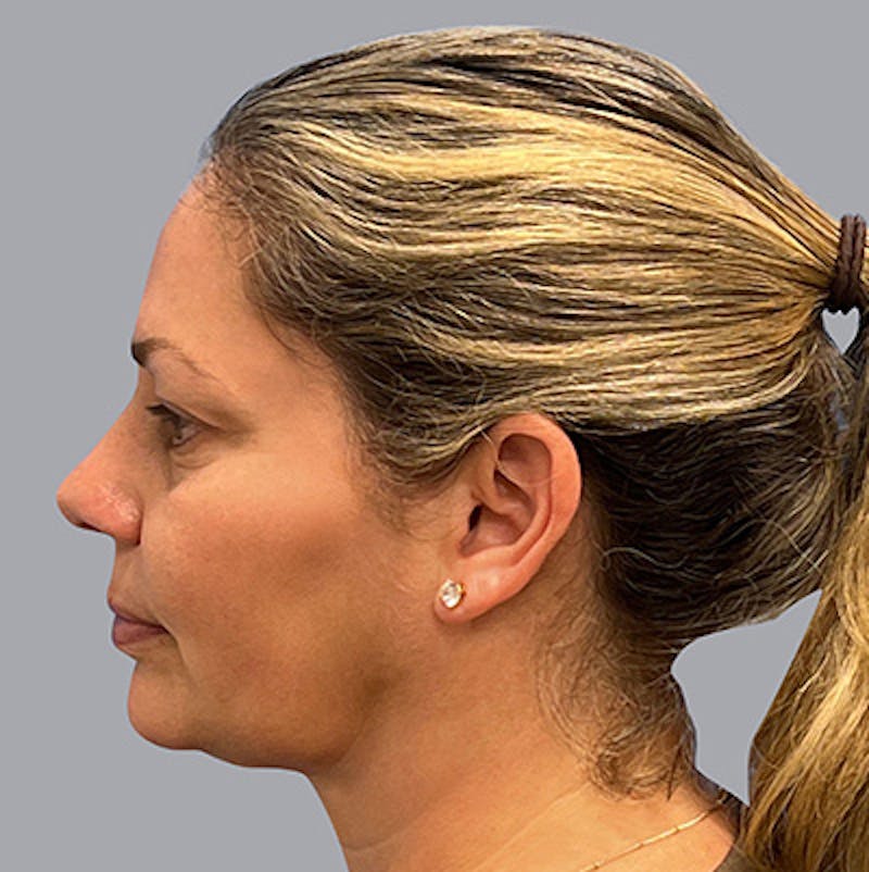 Chin Lipo Before & After Gallery - Patient 106446250 - Image 4