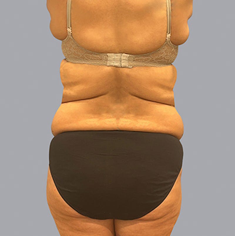 Body Before & After Gallery - Patient 136668 - Image 1