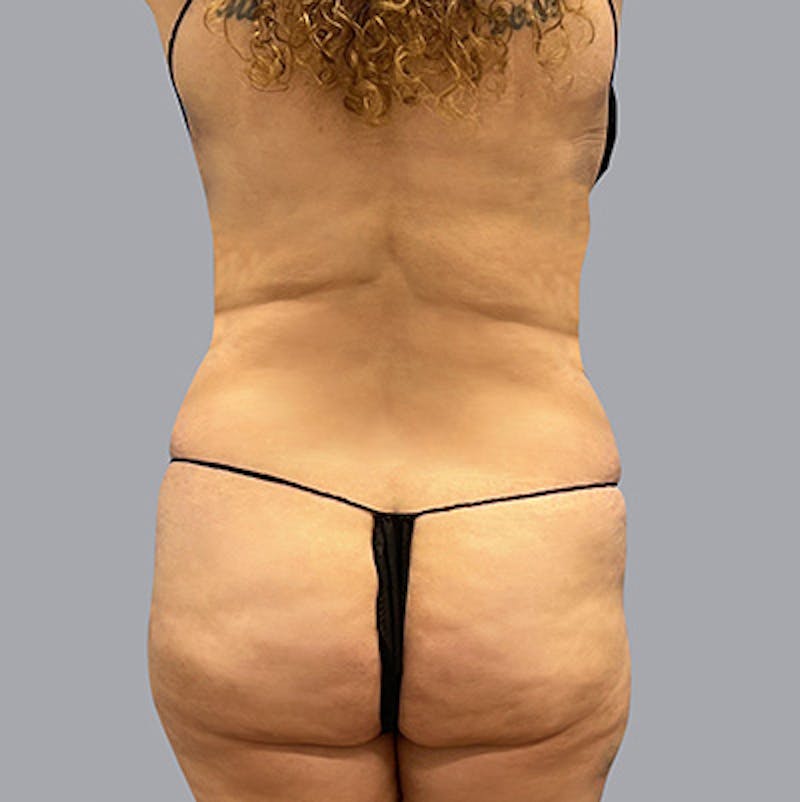 Liposuction Before & After Gallery - Patient 63889791 - Image 2