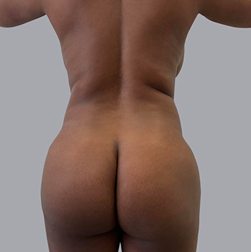 Liposuction Before & After Gallery - Patient 63889792 - Image 1