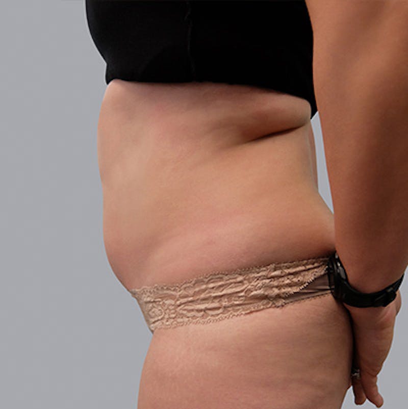 Liposuction Before & After Gallery - Patient 55333020 - Image 1
