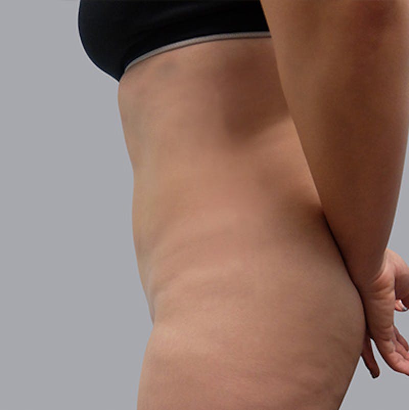 Body Before & After Gallery - Patient 378473 - Image 2