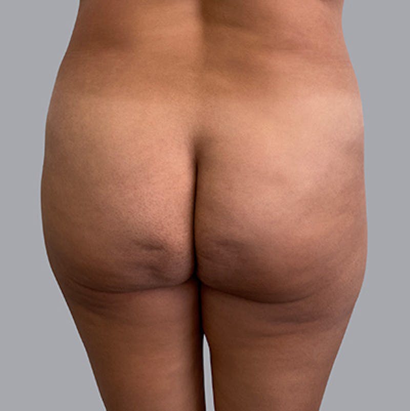 Brazilian Butt Lift and Hip Dip Before & After Gallery - Patient 63984483 - Image 1