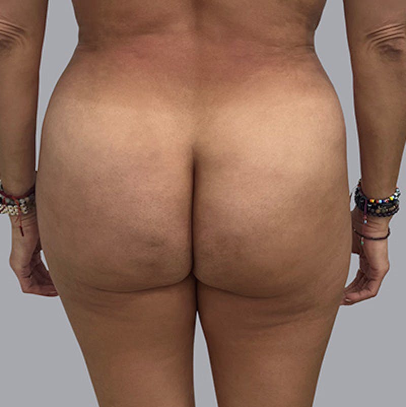 Brazilian Butt Lift Before & After Gallery - Patient 63984483 - Image 2