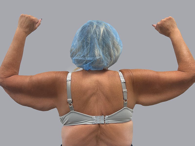 Arm Lift Before & After Gallery - Patient 63984481 - Image 1